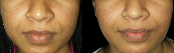 VivaMd Before & After Gallery - Patient 414735 - Image 1