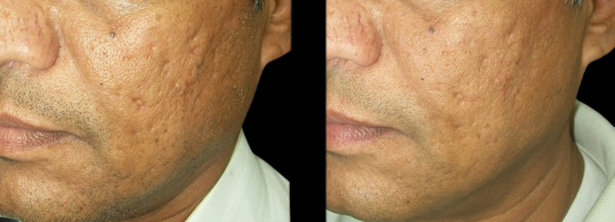 VivaMd Before & After Gallery - Patient 414735 - Image 2