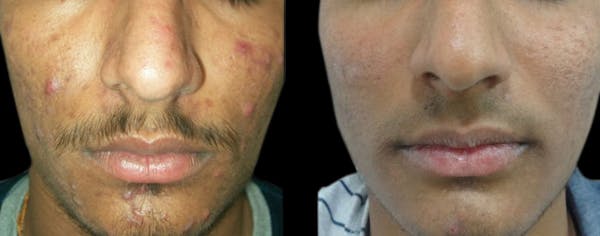 VivaMd Before & After Gallery - Patient 766959 - Image 1