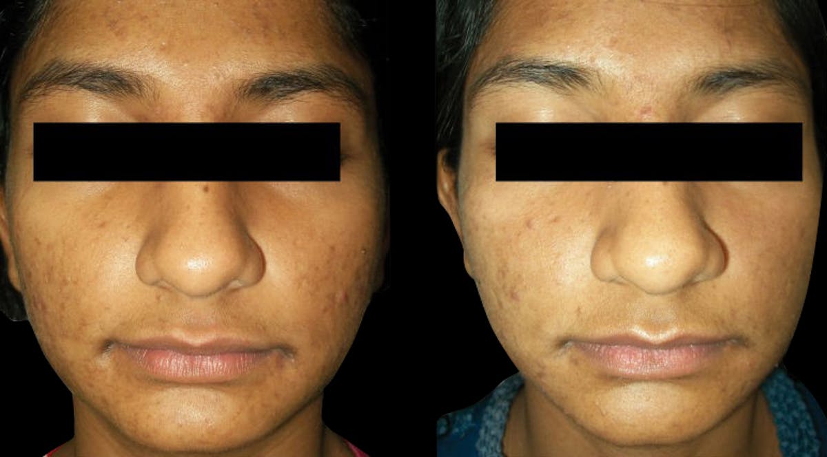 VivaMd Before & After Gallery - Patient 766959 - Image 2