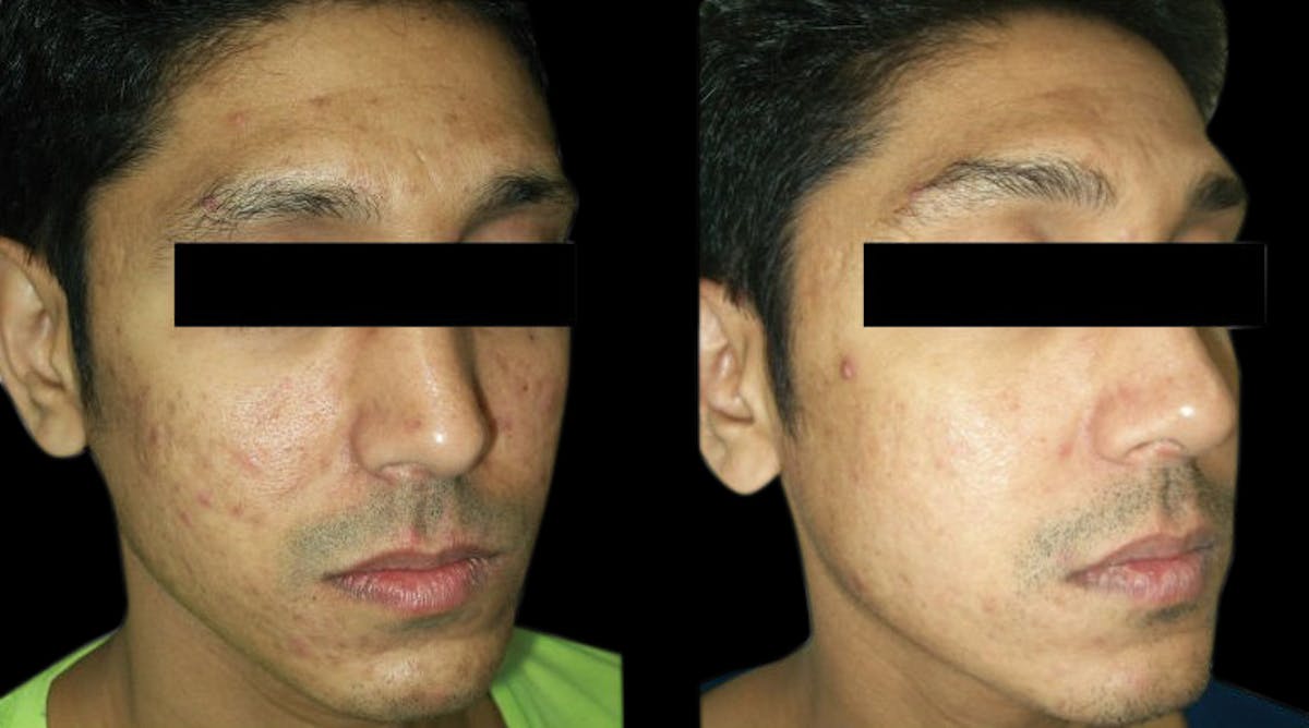VivaMd Before & After Gallery - Patient 297025 - Image 1
