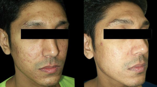 VivaMd Before & After Gallery - Patient 297025 - Image 1