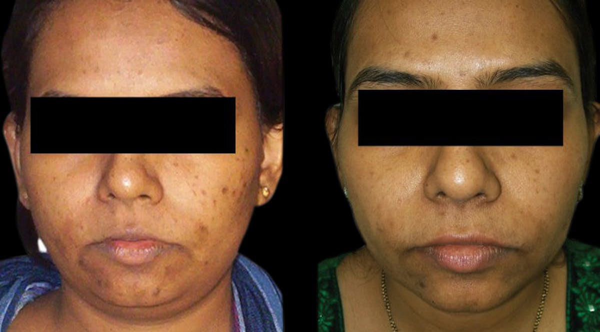 VivaMd Before & After Gallery - Patient 301710 - Image 1