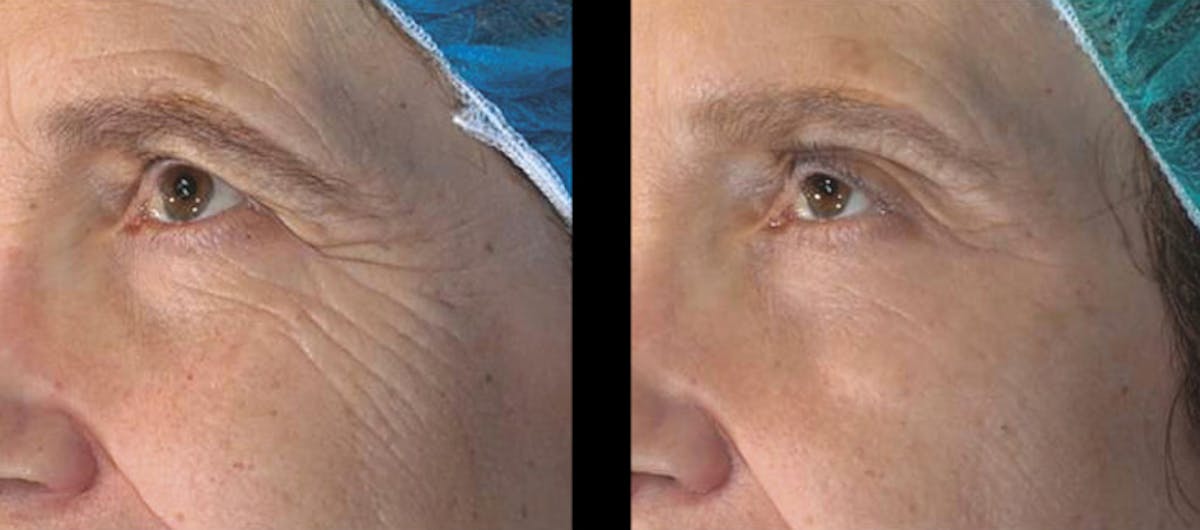 Vivace® Before & After Gallery - Patient 223475 - Image 1