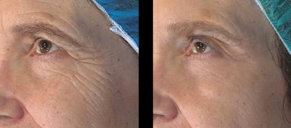 Vivace® Before & After Gallery - Patient 223475 - Image 1