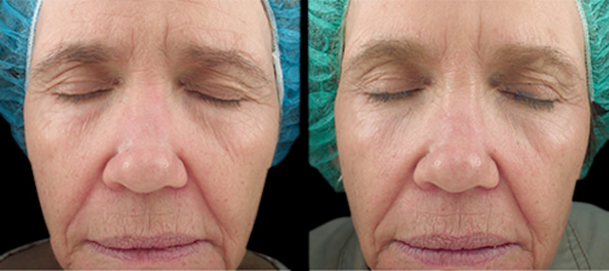Vivace® Before & After Gallery - Patient 223475 - Image 2