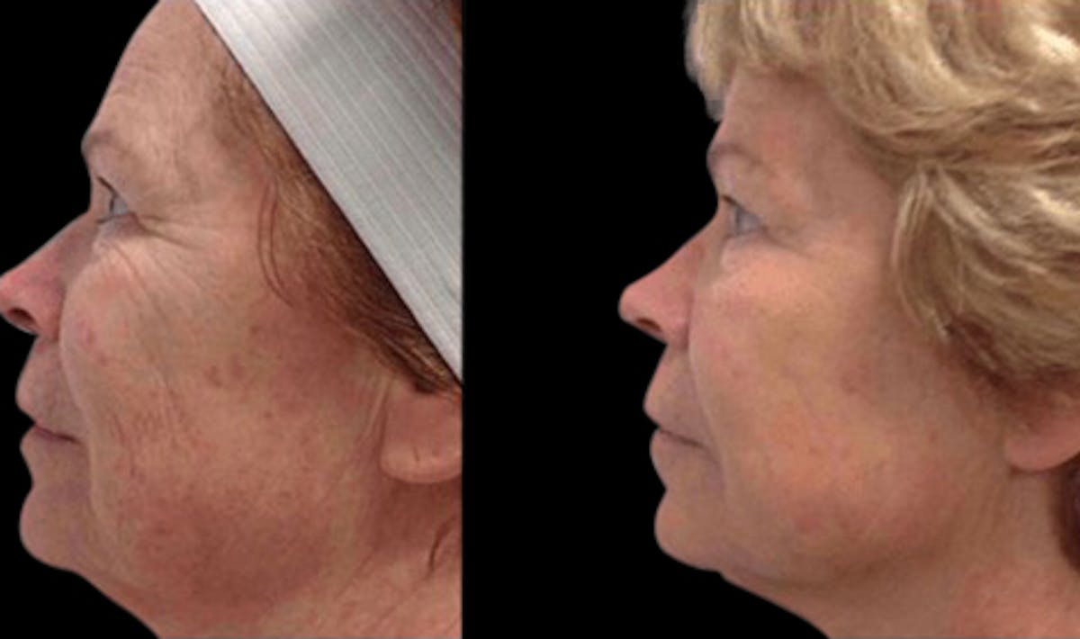Vivace® Before & After Gallery - Patient 313604 - Image 1