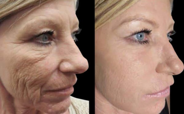 Vivace® Before & After Gallery - Patient 184975 - Image 1