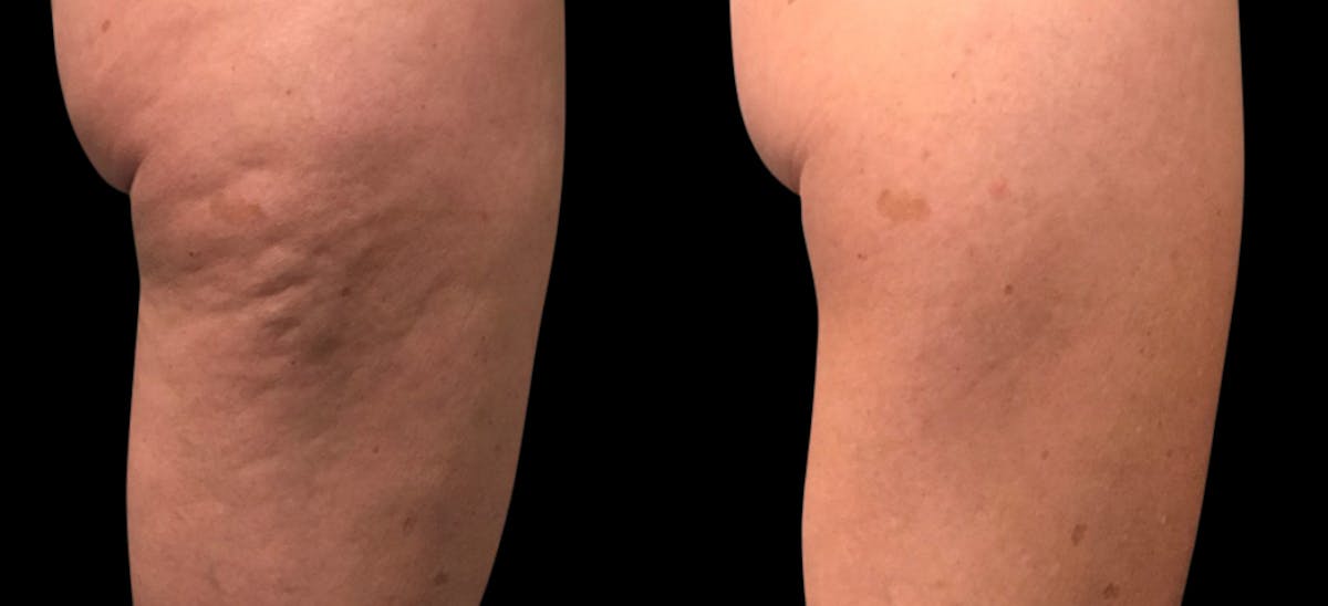 Vivace® Before & After Gallery - Patient 188121 - Image 1