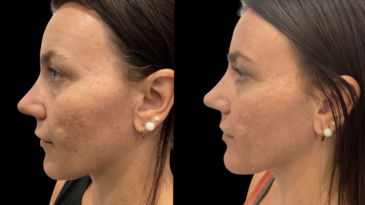 Vivace® Before & After Gallery - Patient 275344 - Image 5