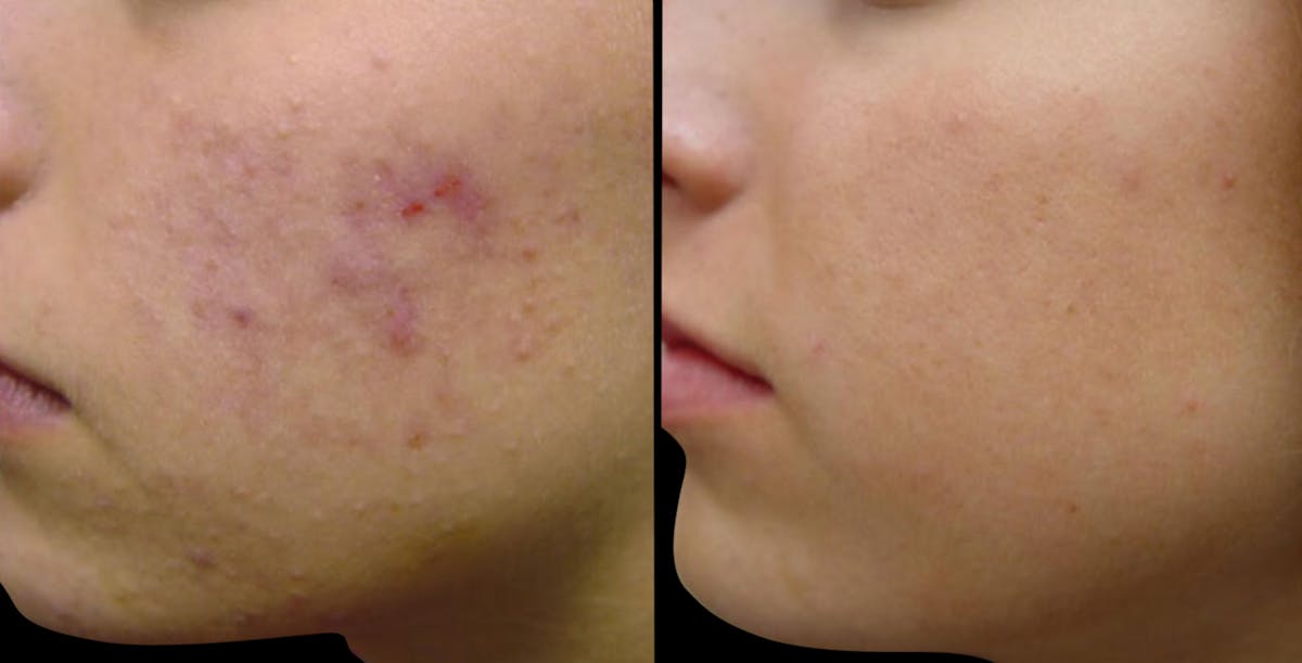 Vivace® Before & After Gallery - Patient 837881 - Image 1