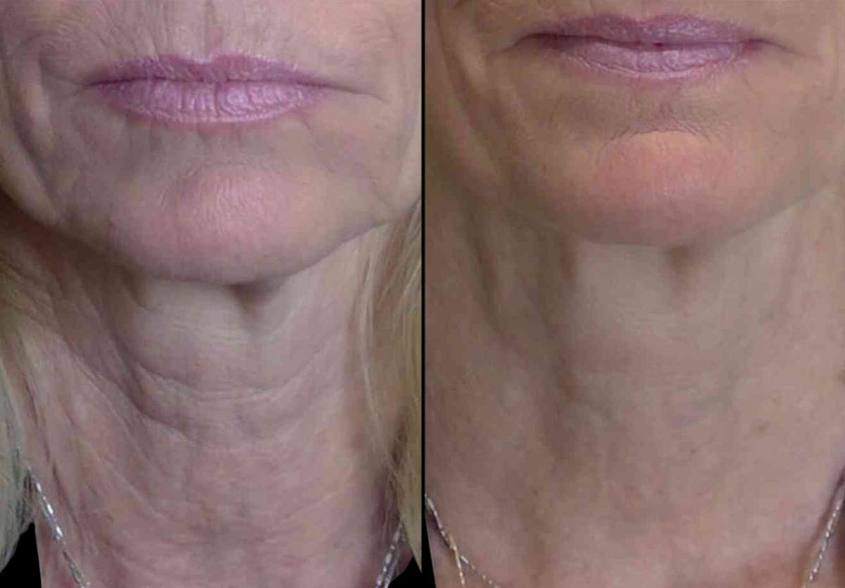Vivace® Before & After Gallery - Patient 346438 - Image 1