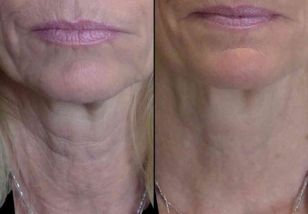Vivace® Before & After Gallery - Patient 346438 - Image 1