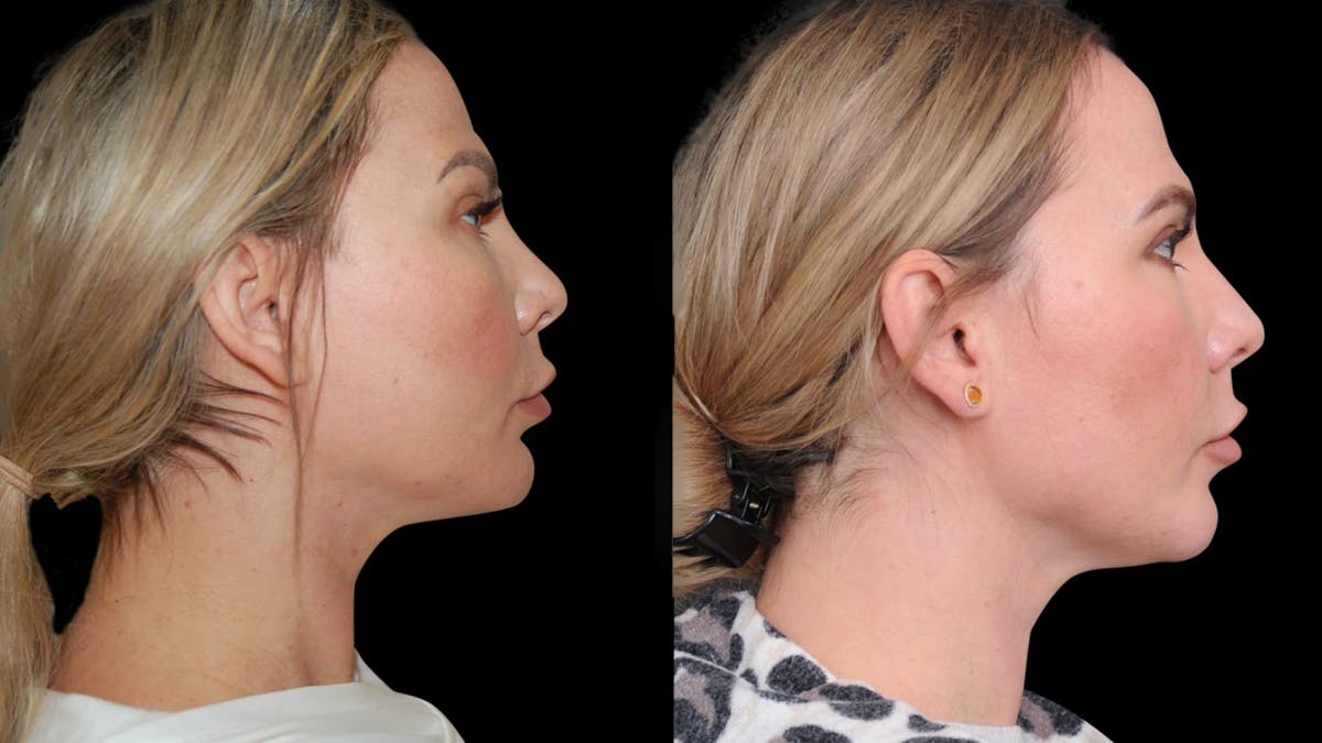 Chin Augmentation Before & After Gallery - Patient 579954 - Image 3