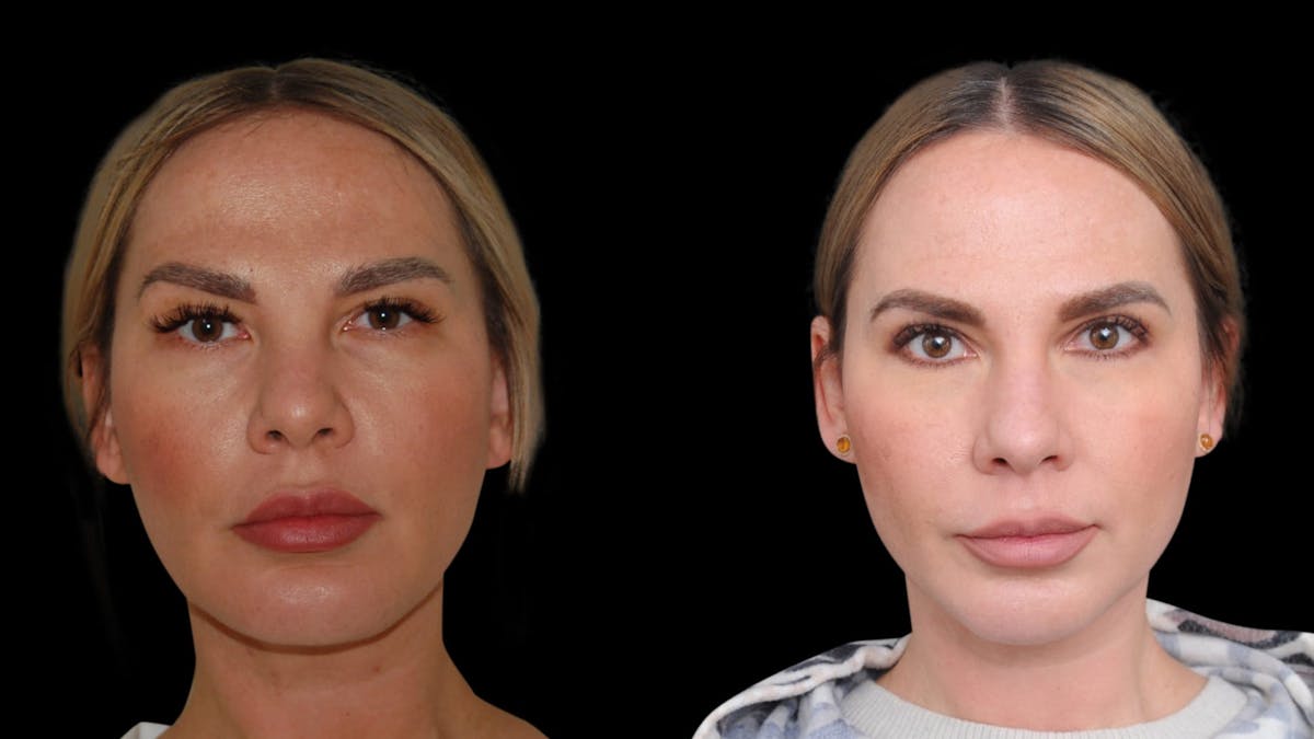 Chin Augmentation Before & After Gallery - Patient 579954 - Image 1