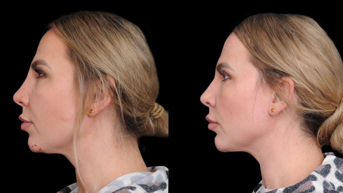 Chin Augmentation Before & After Gallery - Patient 579954 - Image 2