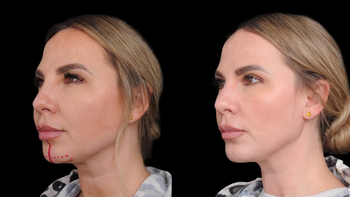 Chin Augmentation Before & After Gallery - Patient 579954 - Image 6