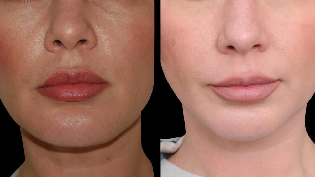 Chin Augmentation Before & After Gallery - Patient 579954 - Image 7