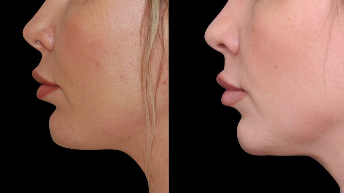 Chin Augmentation Before & After Gallery - Patient 579954 - Image 4
