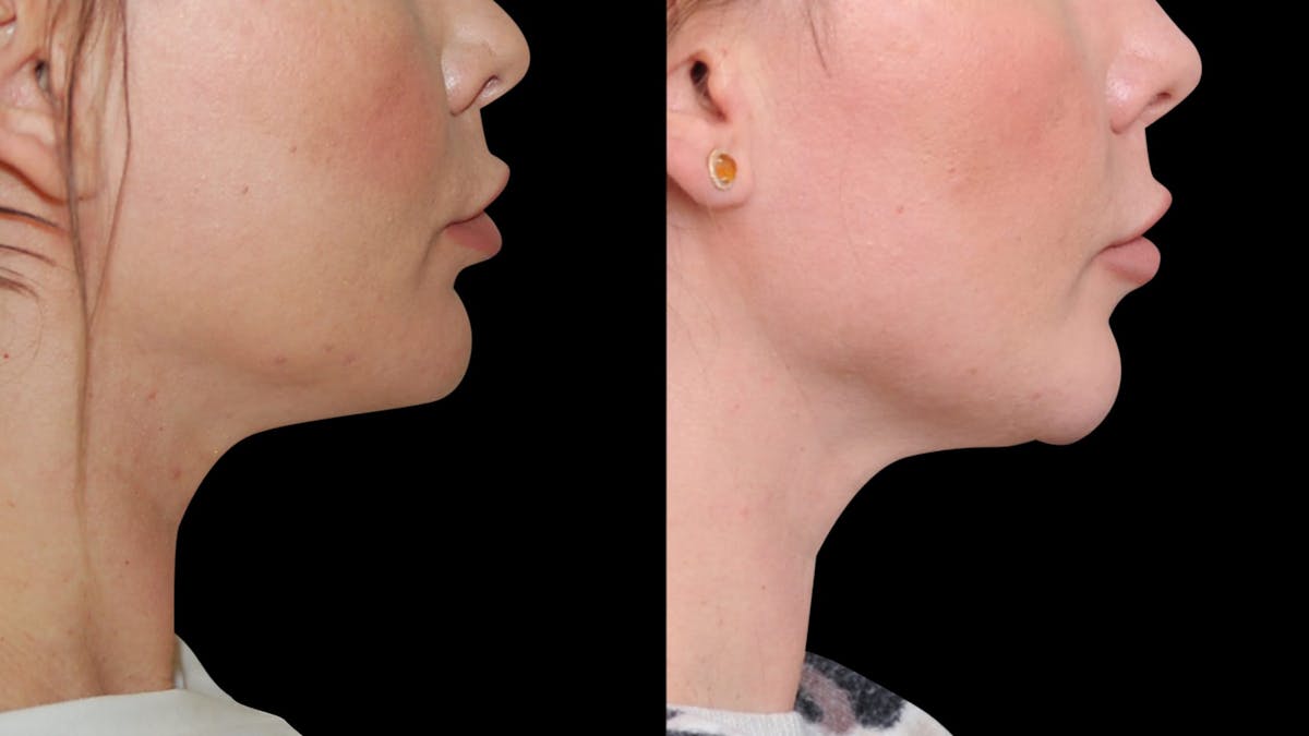 Chin Augmentation Before & After Gallery - Patient 579954 - Image 5