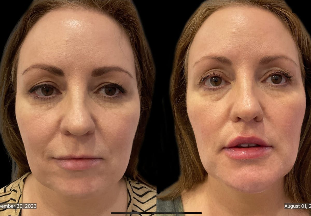 Chin Augmentation Before & After Gallery - Patient 115331 - Image 1