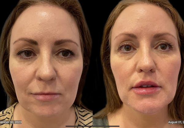 Chin Augmentation Before & After Gallery - Patient 115331 - Image 1