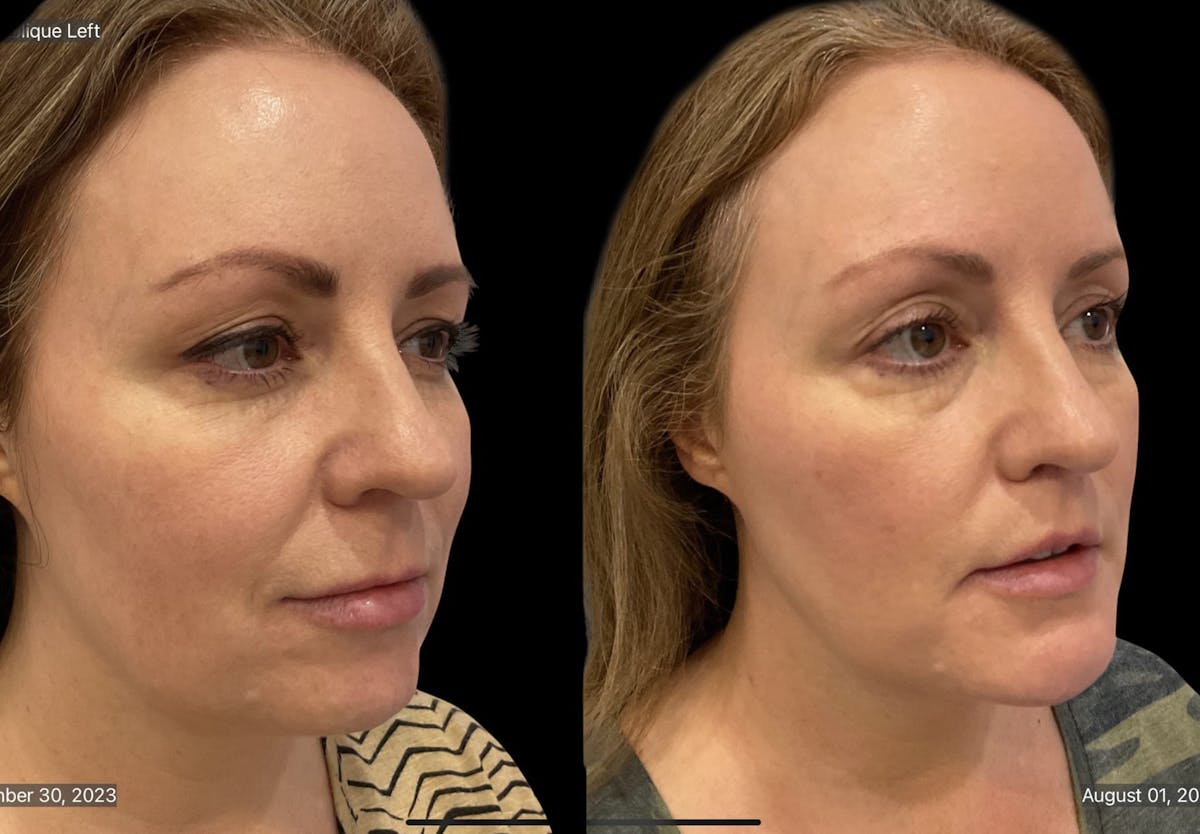 Chin Augmentation Before & After Gallery - Patient 115331 - Image 8