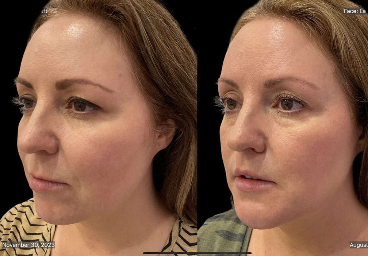 Chin Augmentation Before & After Gallery - Patient 115331 - Image 4