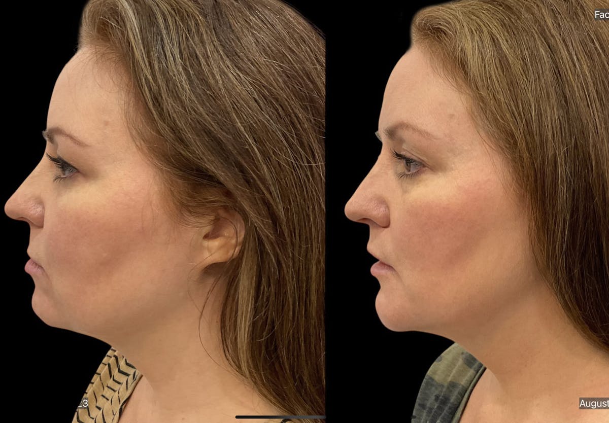 Chin Augmentation Before & After Gallery - Patient 115331 - Image 2