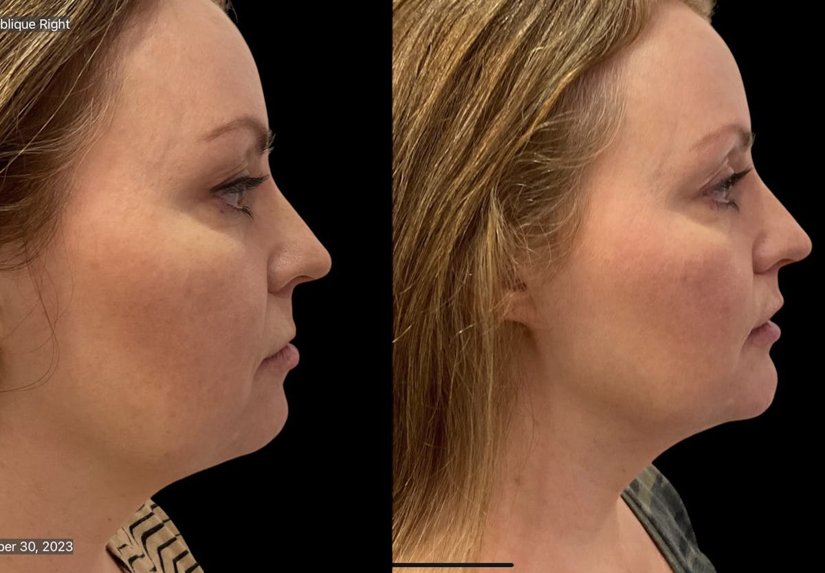 Chin Augmentation Before & After Gallery - Patient 115331 - Image 5