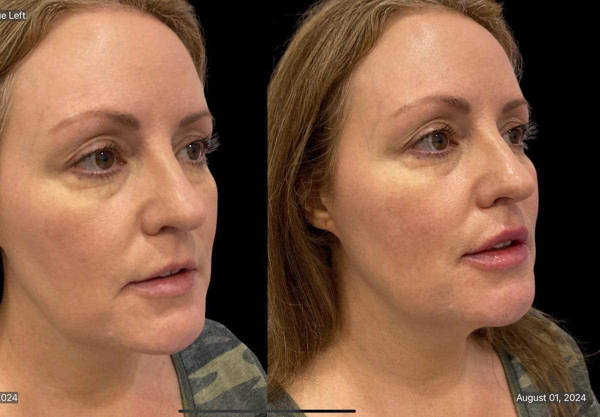 Chin Augmentation Before & After Gallery - Patient 115331 - Image 3