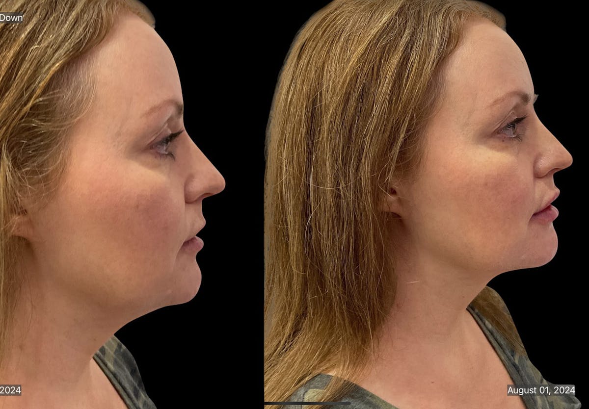 Chin Augmentation Before & After Gallery - Patient 115331 - Image 7