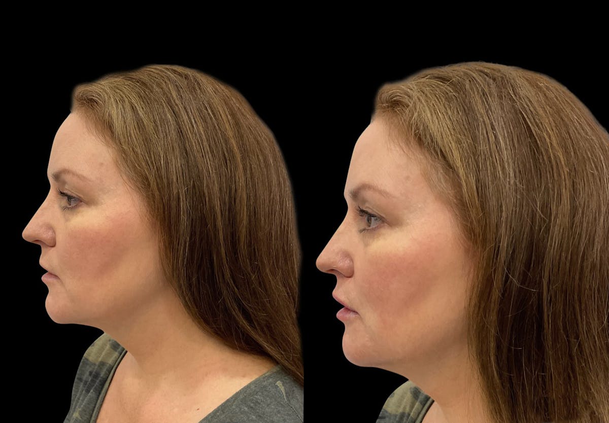 Chin Augmentation Before & After Gallery - Patient 115331 - Image 6