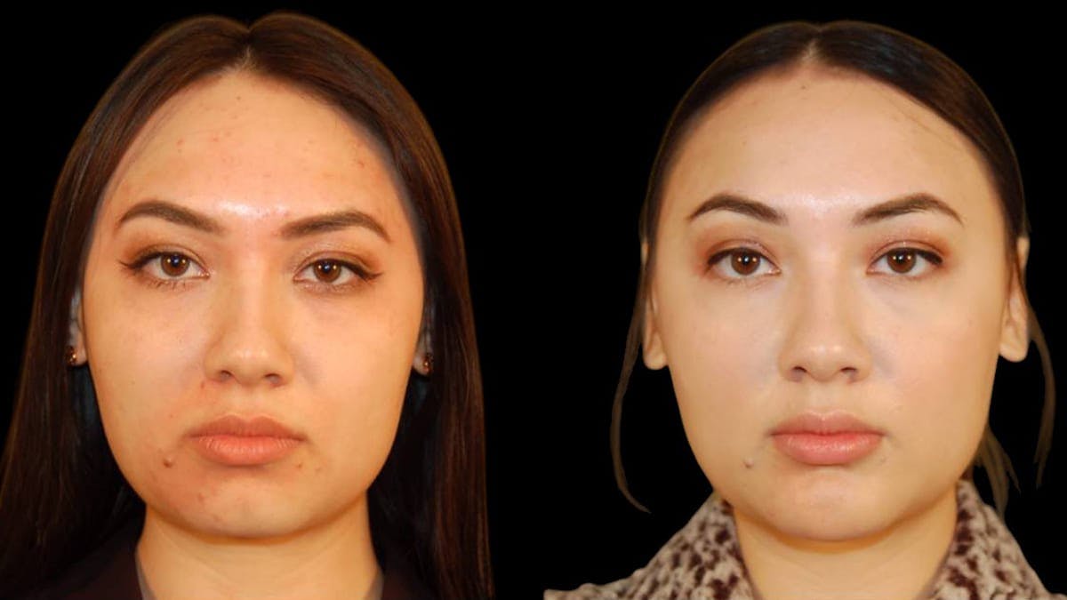 Chin Augmentation Before & After Gallery - Patient 350667 - Image 1