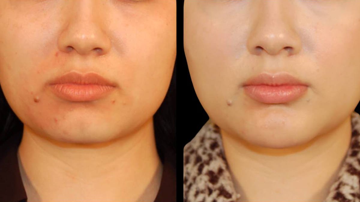 Chin Augmentation Before & After Gallery - Patient 350667 - Image 6
