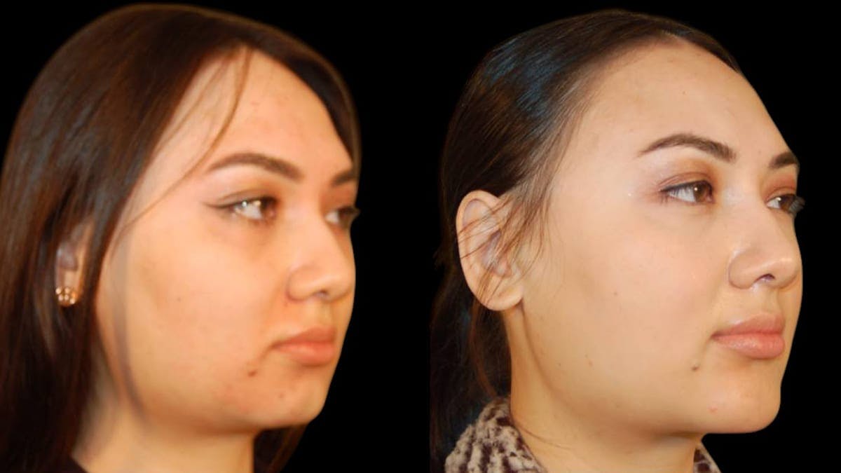 Chin Augmentation Before & After Gallery - Patient 350667 - Image 3
