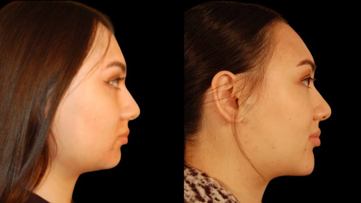 Chin Augmentation Before & After Gallery - Patient 350667 - Image 4