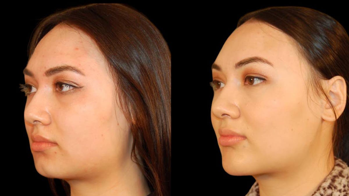 Chin Augmentation Before & After Gallery - Patient 350667 - Image 5