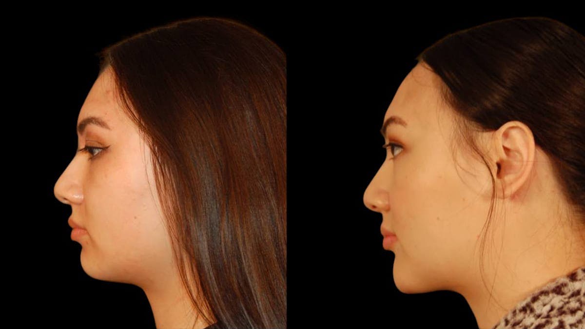 Chin Augmentation Before & After Gallery - Patient 350667 - Image 2