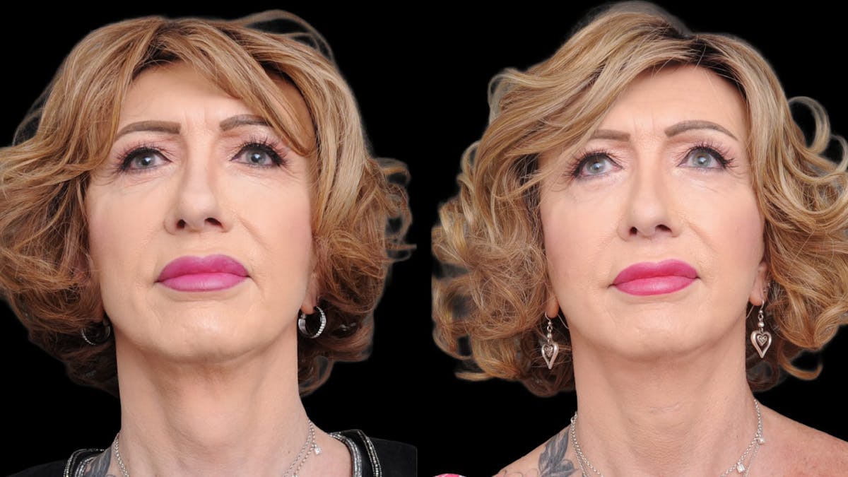 Facial Feminization Before & After Gallery - Patient 112185 - Image 3
