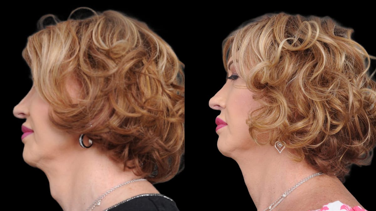 Facial Feminization Before & After Gallery - Patient 112185 - Image 5