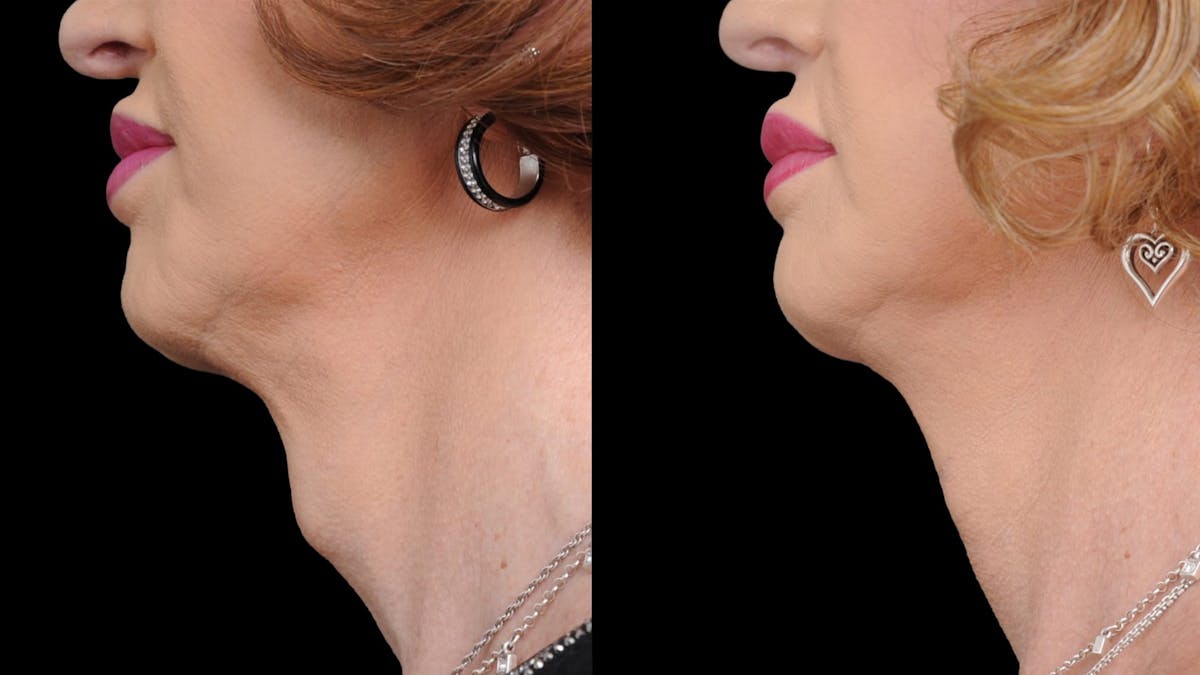 Facial Feminization Before & After Gallery - Patient 112185 - Image 1