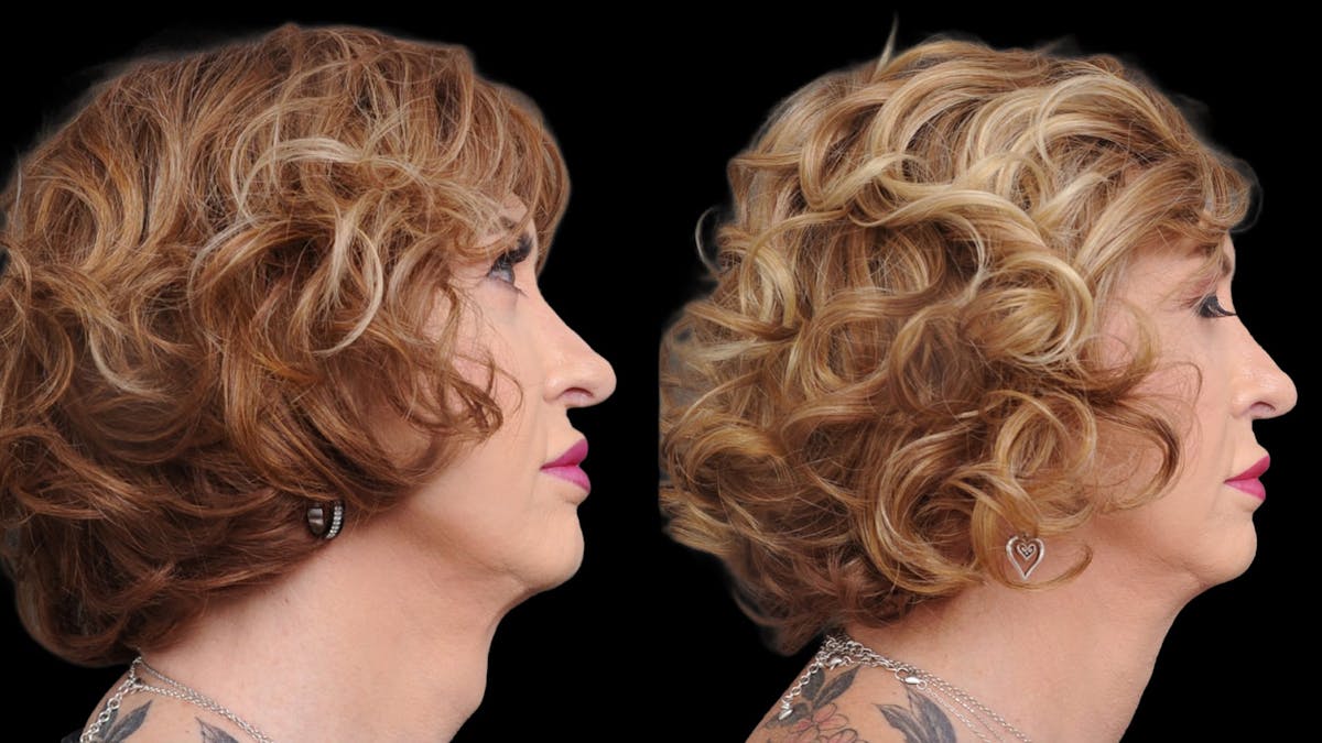 Facial Feminization Before & After Gallery - Patient 112185 - Image 2