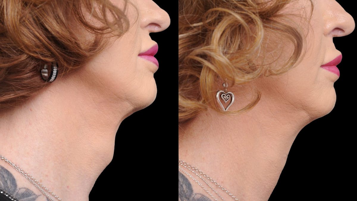 Facial Feminization Before & After Gallery - Patient 112185 - Image 4