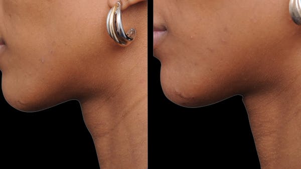 Facial Feminization Before & After Gallery - Patient 198882 - Image 1