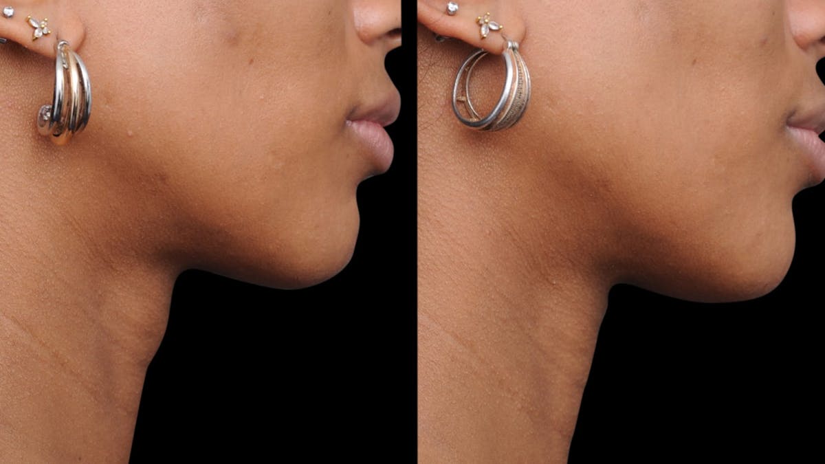 Facial Feminization Before & After Gallery - Patient 198882 - Image 2