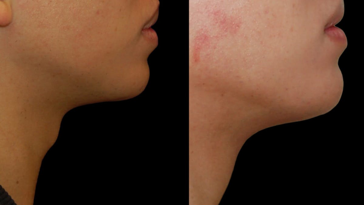 Facial Feminization Before & After Gallery - Patient 289752 - Image 2