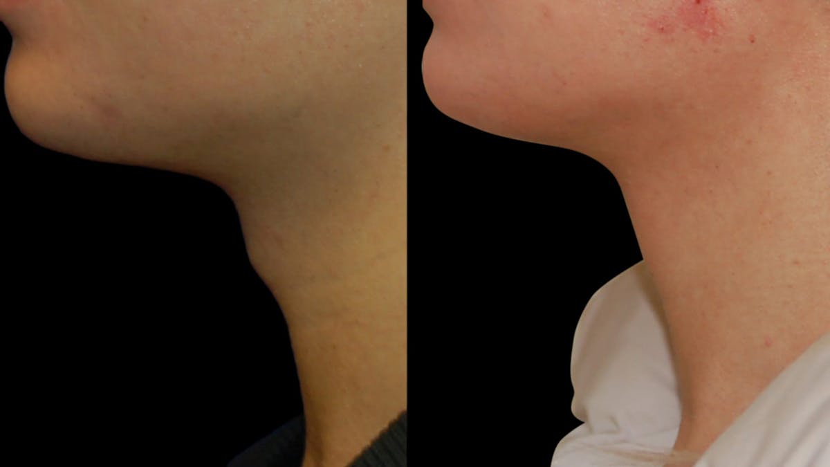 Facial Feminization Before & After Gallery - Patient 289752 - Image 1