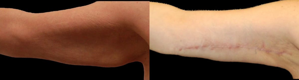 Arm Lift Before & After Gallery - Patient 226409 - Image 1