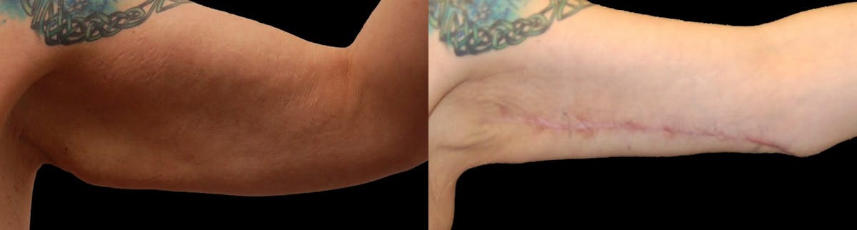 Arm Lift Before & After Gallery - Patient 226409 - Image 3